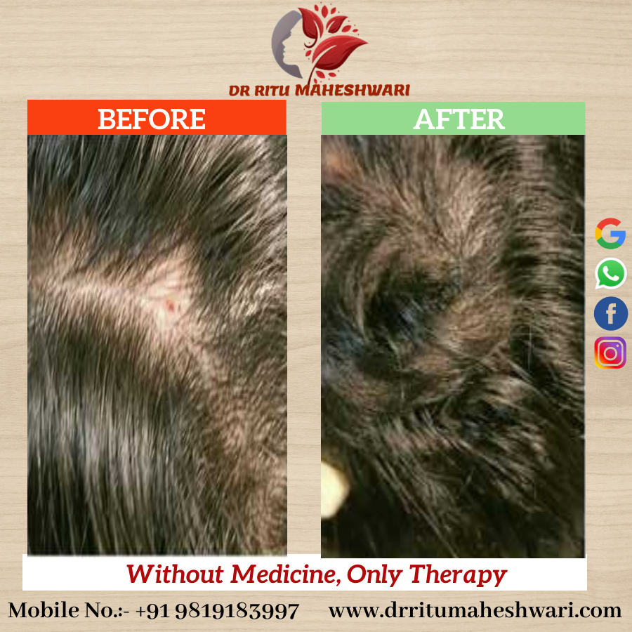 Hair Loss Treatment only with Therapy
